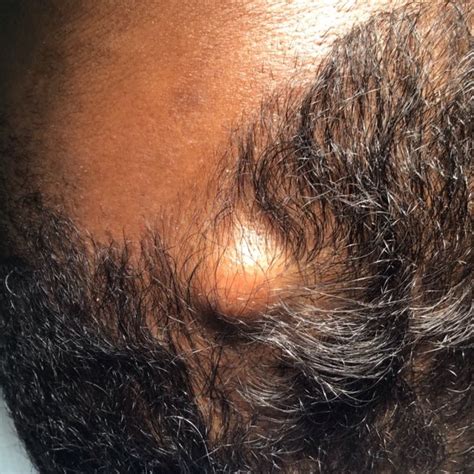 Pilar Cyst Removal: Causes, Treatment Options, and Recovery