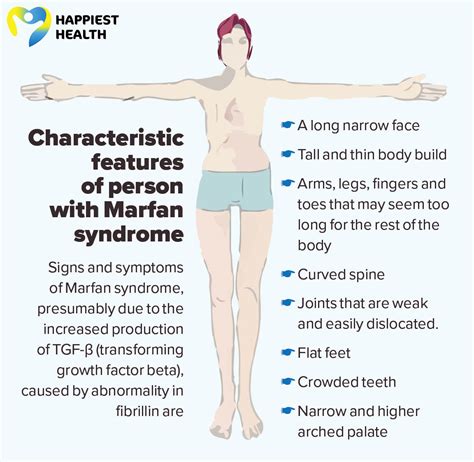 Marfan syndrome: Cause and Diagnosis | Happiest Health
