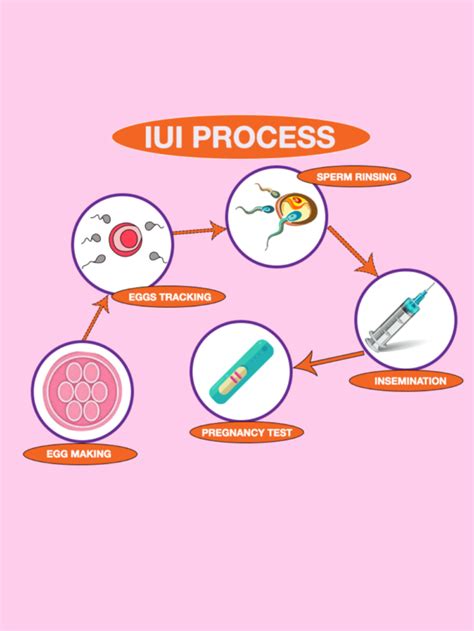 How Is IUI Procedure Done 的图像结果