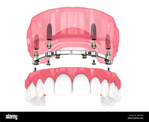 Bar retained removable overdenture installation supported by implants ...