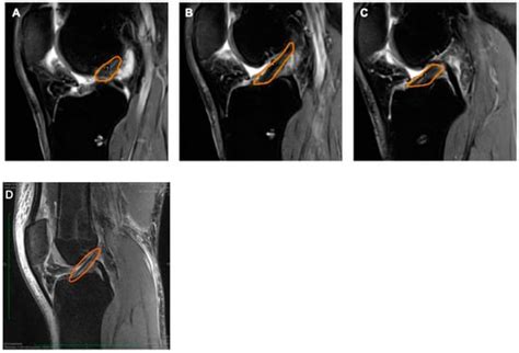 Extracorporeal Shockwave Therapy Improves Outcome after Primary ...