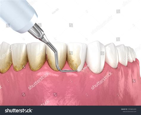 Oral Hygiene Scaling Root Planing Conventional: Stockillusztráció 1955865499 | Shutterstock