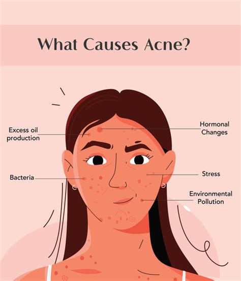 7 top-rated acne spot treatments by Sublime Life for your acne scars