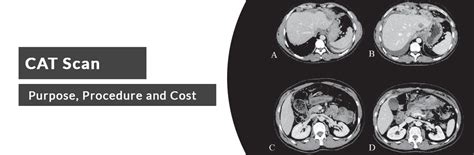 Image result for Cat Scan Risks