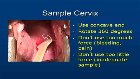 Image result for Cervical Screening Explained