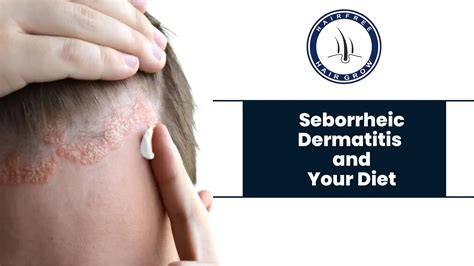 Seborrheic Dermatitis Face Cream