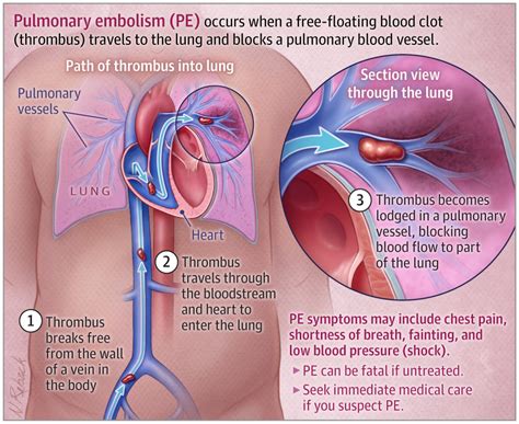 What is a pulmonary embolism, the condition that led to Catherine O’Hara’s death? | CNN