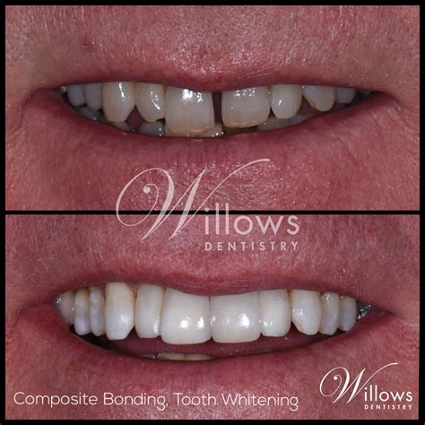 Composite Bonding - Willows Dentistry