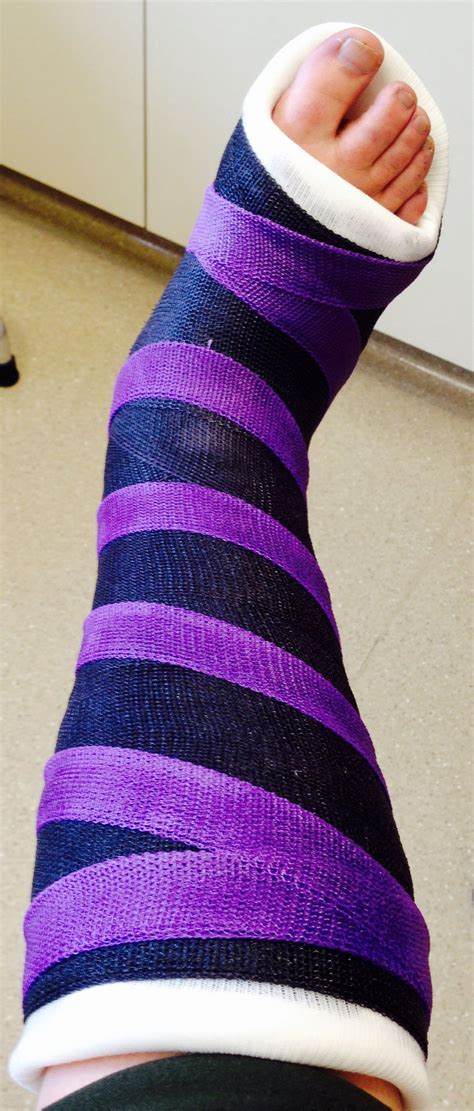 My spiffy new cast which my daughter has dubbed the "Cheshire Cast ...