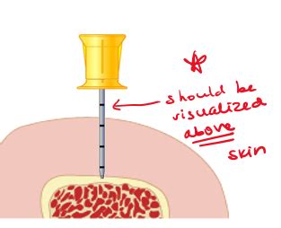 Image result for Intraosseous Access Procedure