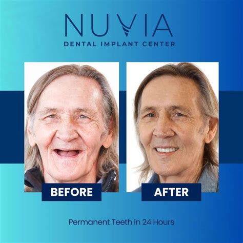 24 Hour Dental Implants in Tampa FL