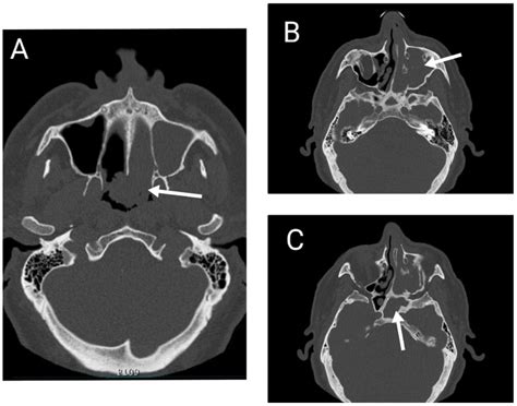 The Role of Inverted Papilloma Surgical Removal for Sleep Apnea ...