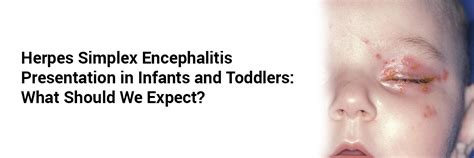 Herpes Simplex Encephalitis presentation in Infants and Toddlers: what ...