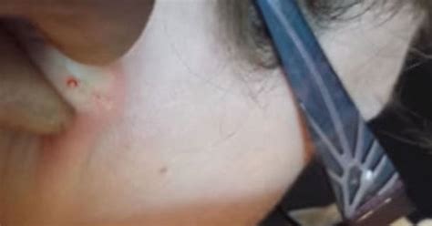 Image result for Extreme Zit Exploding