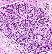 Image result for 血管内皮瘤