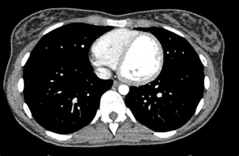 File:Normal dual phase CT chest, abdomen and pelvis (trauma protocol ...