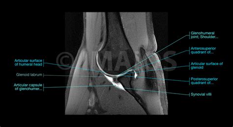 Mr Arthrogram Shoulder 的图像结果
