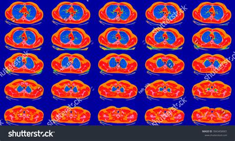 Image result for Poumon Normal Scanner