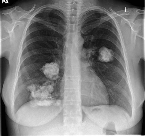 Calcified pulmonary chondromas in Carney's triad | Thorax