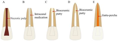 Bioceramics in Endodontics: Updates and Future Perspectives