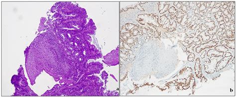 Gastro-Esophageal Junction Precancerosis: Histological Diagnostic ...