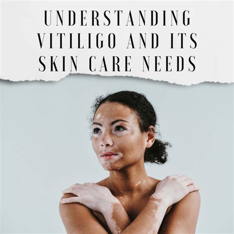 Navigating Skin Care with Vitiligo: A Comprehensive Guide | Clinikally