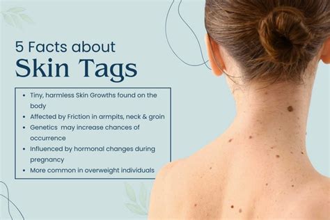 What are Skin Tags? – Know the Possible Causes & Treatment Methods