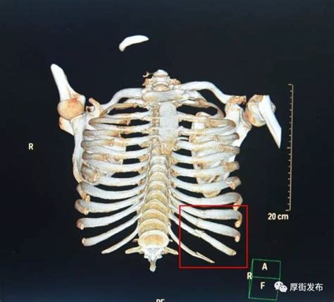 肋骨ct图解,肋骨t怎么看,左侧肋骨骨折t图片_大山谷图库