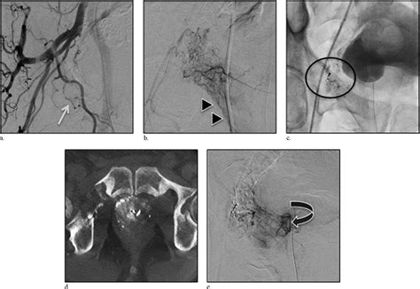 Role of Coil Embolization during Prostatic Artery Embolization ...