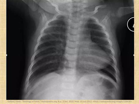 The boot shaped heart sign | PPTX