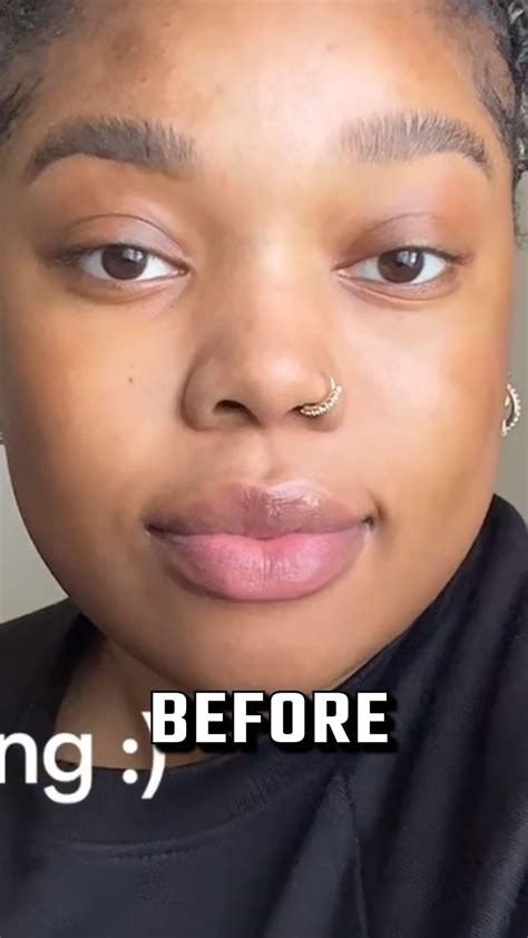 Jaw surgery ruined my face (before/after) : r/jawsurgery