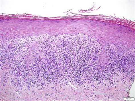 Erosive Lichen Planus Histology Macroscopic, Microscopic And Immune