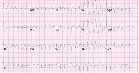 Image result for AFib Detection Algorithm