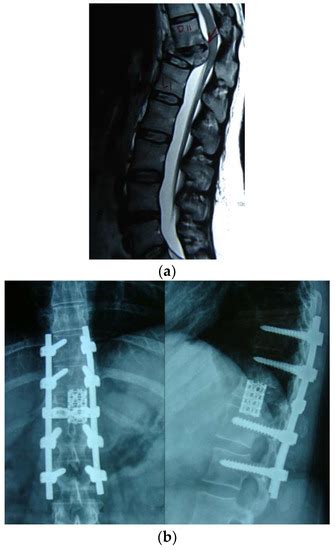 Surgical Management of Spinal Tuberculosis—The Past, Present, and Future