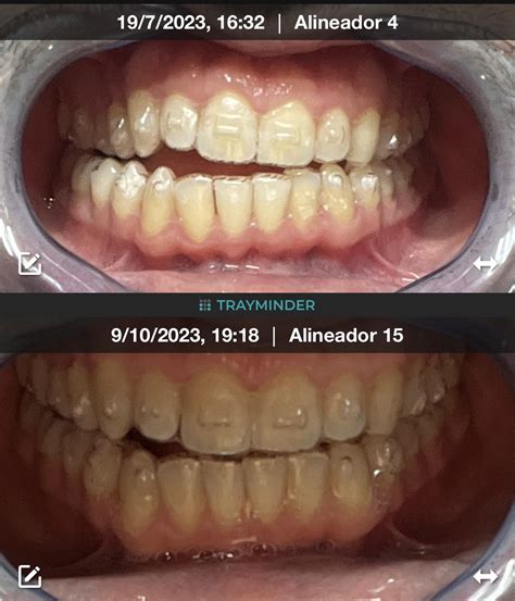 Invisalign before/after bone graft : r/Invisalign