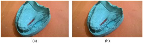 Oronasal Fistula and Complete Edentulism: What to Do?