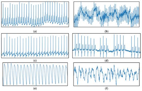 Atrial Fibrillation Classification with Smart Wearables Using Short ...