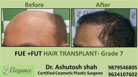 Grade 7 in Hair Transplant Treatment Kosamba, Gujarat, India.