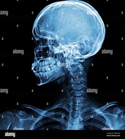 Lateral Skull X Ray Labeled at Diane Gilbreath blog