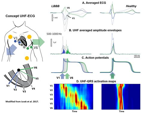 Ultra-High-Frequency ECG in Cardiac Pacing and Cardiac ...