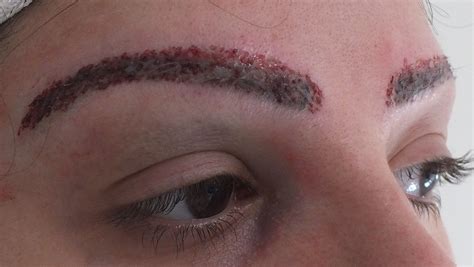 Eyebrow Transplant Design - Female | Eyebrow transplant, Hair transplant, Hair restoration