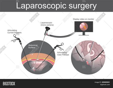 Understanding The Benefits Of The Laparoscopic Fundoplication Operation ...