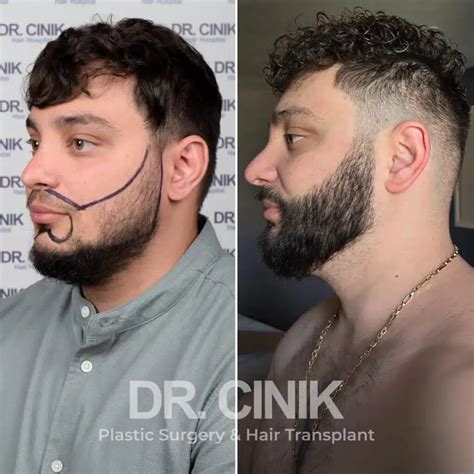 Beard Transplant Cost