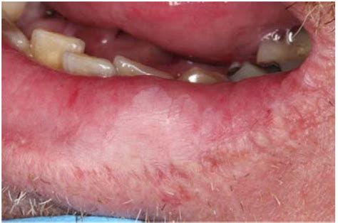 Erythroplakia Floor Of Mouth