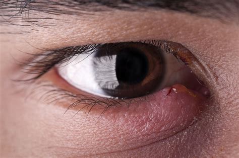 Swollen Eyelid: 9 Common Causes