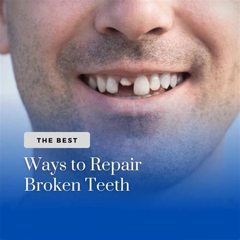 Broken Tooth Repair Renewing Your Smile: Options For Chipped Or Broken