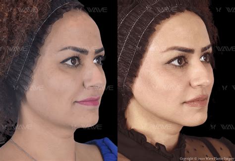 New Thread Lift 的图像结果