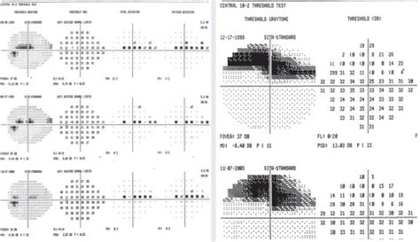 Image result for Paracentral Visual Field Defect