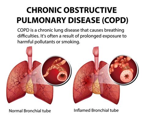 Emphysema Life Expectancy 的图像结果