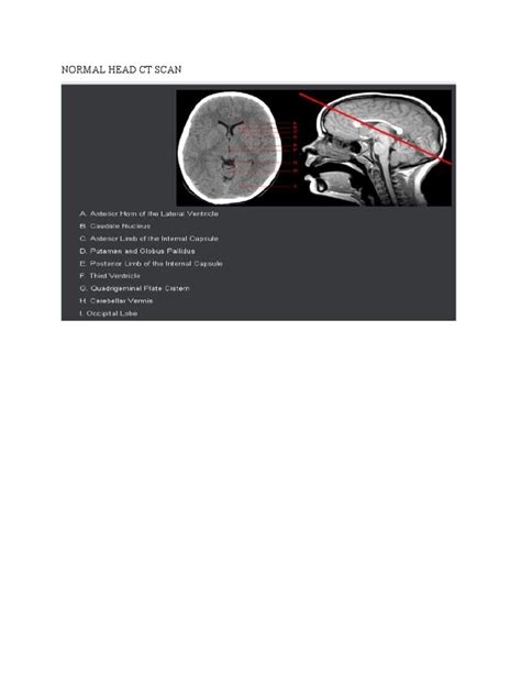 Image result for Normal Brain CT Scan Head